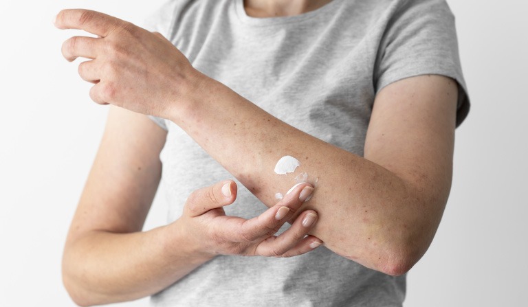 Dermatitis Atópica: Qué es, tratamientos y consejos para el Cuidado de la Piel